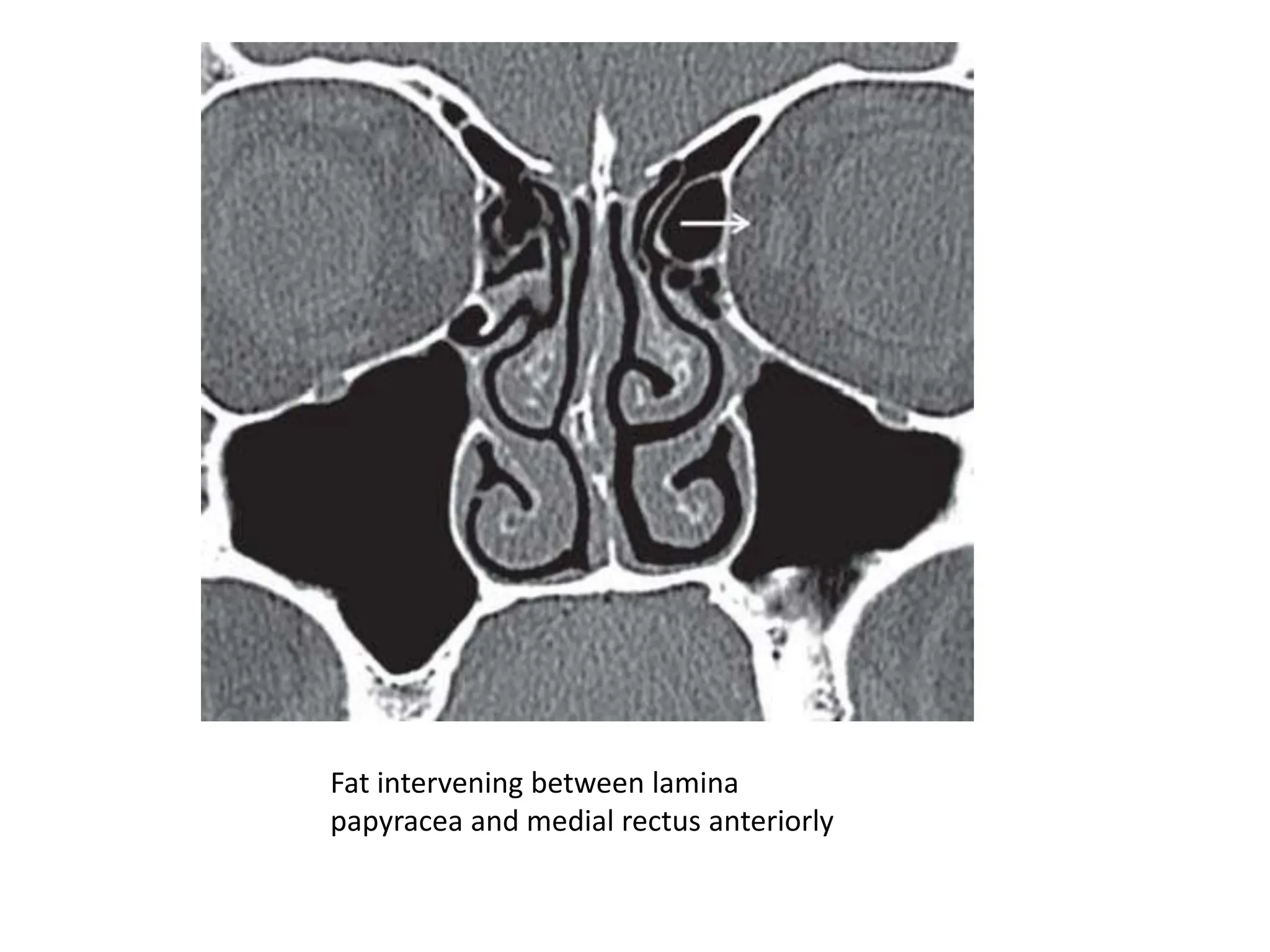 Fat intervening between lamina
papyracea and medial rectus anteriorly
 