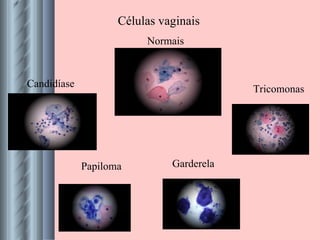 Células vaginais Normais Candidíase Papiloma Tricomonas Garderela 