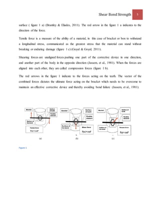 Shear Bond Strength 5 
surface ( figure 1 a) (Brantley & Eliades, 2011). The red arrow in the figure 1 a indicates to the 
direction of the force. 
Tensile force is a measure of the ability of a material, in this case of bracket or bon to withstand 
a longitudinal stress, communicated as the greatest stress that the material can stand without 
breaking or enduring damage (figure 1 c) (Goyal & Goyal, 2011). 
Shearing forces are unaligned forces pushing one part of the corrective device in one direction, 
and another part of the body in the opposite direction (Jassem, et al., 1981). When the forces are 
aligned into each other, they are called compression forces (figure 1 b). 
The red arrows in the figure 1 indicate to the forces acting on the teeth. The vector of the 
combined forces dictates the ultimate force acting on the bracket which needs to be overcome to 
maintain an effective corrective device and thereby avoiding bond failure (Jassem, et al., 1981). 
Figure 1 
 