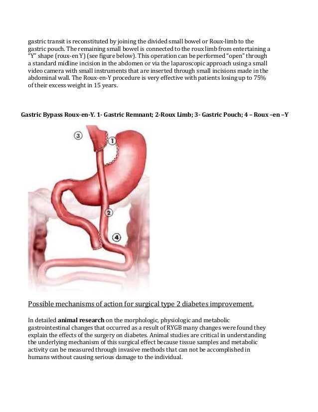 Bariatric surgery for the treatment of Type II Diabetes
