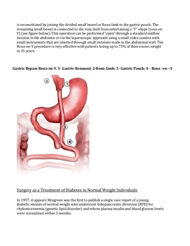 Surgery for treatment of Diabetes