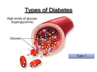 Types of Diabetes
Type 1
 