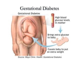Gestational Diabetes
Source: Mayo Clinic. Health: Gestational Diabetes
 