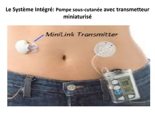 Le Système Intégré: Pompe sous-cutanée avec transmetteur
                      miniaturisé
 