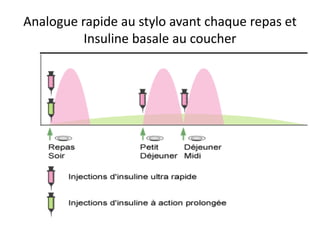 Analogue rapide au stylo avant chaque repas et
          Insuline basale au coucher
 