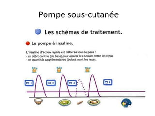 Pompe sous-cutanée
 
