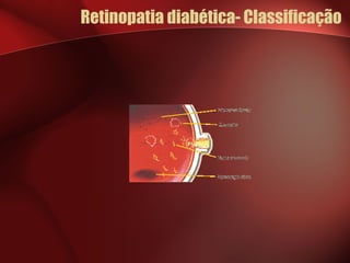 Retinopatia diabética- Classificação 