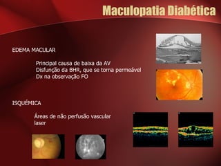 Maculopatia Diabética EDEMA MACULAR    Principal causa de baixa da AV   Disfunção da BHR, que se torna permeável   Dx na observação FO    ISQUÉMICA Áreas de não perfusão vascular laser 