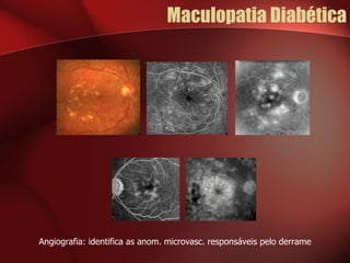 Maculopatia Diabética Angiografia: identifica as anom. microvasc. responsáveis pelo derrame 