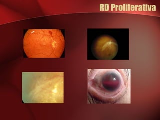 RD Proliferativa 