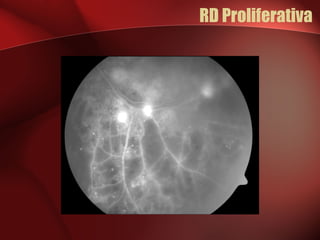 RD Proliferativa 
