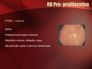 RD Pré- proliferativa  ETDRS - critérios IRMAs Múltiplas hemorragias retinianas Alterações venosas: dilatação, loops Não perfusão capilar e derrame disseminado 