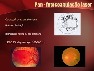 Pan - fotocoagulação laser Características de alto risco Neovascularização Hemorragia vítrea ou pré-retiniana 1500-2500 disparos, spot 200-500  μ m 