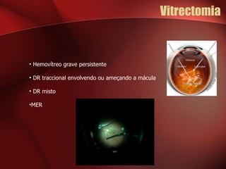 Vitrectomia Hemovítreo grave persistente DR traccional envolvendo ou ameçando a mácula DR misto MER 