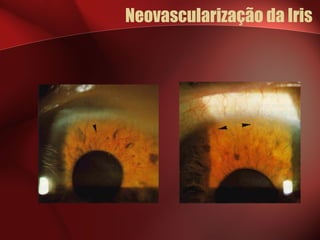 Neovascularização da Iris 
