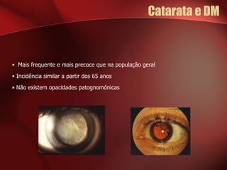 Catarata e DM  Mais frequente e mais precoce que na população geral Incidência similar a partir dos 65 anos  Não existem opacidades patognomónicas  