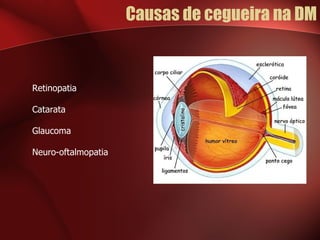 Causas de cegueira na DM Retinopatia Catarata Glaucoma Neuro-oftalmopatia 