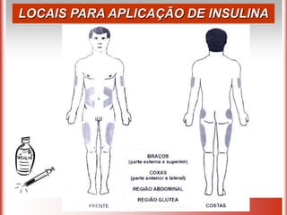LOCAIS PARA APLICAÇÃO DE INSULINA
 
