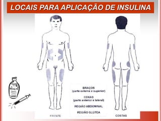 LOCAIS PARA APLICAÇÃO DE INSULINA
 