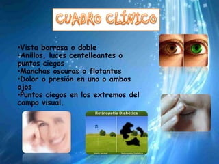 •Vista borrosa o doble
•Anillos, luces centelleantes o
puntos ciegos
•Manchas oscuras o flotantes
•Dolor o presión en uno o ambos
ojos
•Puntos ciegos en los extremos del
campo visual.
 