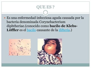 QUE ES ?

 Es una enfermedad infecciosa aguda causada por la
 bacteria denominada Corynebacterium
 diphtheriae.(conocido como bacilo de Klebs-
 Löffler es el bacilo causante de la difteria.)
 