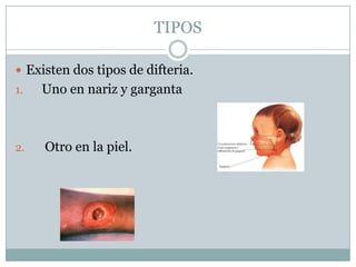 TIPOS

 Existen dos tipos de difteria.
1.   Uno en nariz y garganta



2.   Otro en la piel.
 