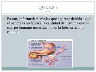 QUE ES ?

 Es una enfermedad crónica que aparece debido a que
 el páncreas no fabrica la cantidad de insulina que el
 cuerpo humano necesita, o bien la fabrica de una
 calidad
 
