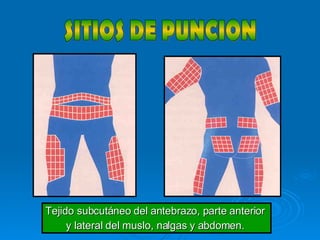 SITIOS DE PUNCION Tejido subcutáneo del antebrazo, parte anterior  y lateral del muslo, nalgas y abdomen.  