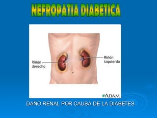 NEFROPATIA DIABETICA DAÑO RENAL POR CAUSA DE LA DIABETES 