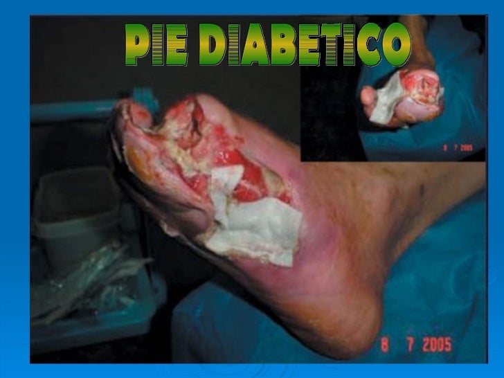 Diabetes Mellitus Tipo 1 Diabetes Mellitus Tipo 1