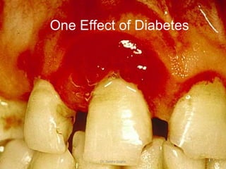 One Effect of Diabetes Dr. Sunita Gupta 