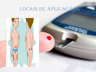 LOCAIS DE APLICAÇÃO
 