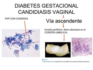 Diabetes: ANATOMIA PATOLÓGICA DE NEUROPATIA, MICROANGIOPATIA, DIABETES ...