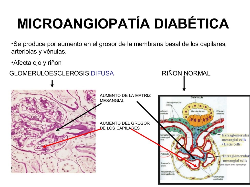 Diabetes: ANATOMIA PATOLÓGICA DE NEUROPATIA Diabetes: ANATOMIA PATOLÓGICA DE NEUROPATIA
