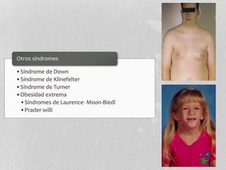 •Síndrome de Down
•Síndrome de Klinefelter
•Síndrome de Turner
•Obesidad extrema
•Síndromes de Laurence- Moon-Biedl
•Prader willi
Otros síndromes
 