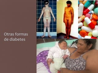 Otras formas
de diabetes
 