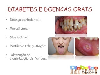 DIABETES E DOENÇAS ORAIS
• Doença periodontal;
• Xerostomia;
• Glossodinia;
• Distúrbios de gustação;
• Alteração na
cicatrização de feridas;
Thais Checon
 