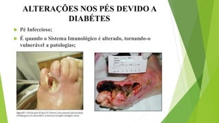 ALTERAÇÕES NOS PÉS DEVIDO A
DIABÉTES
 Pé Infeccioso;
 É quando o Sistema Imunológico é alterado, tornando-o
vulnerável a patologias;
 