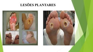 LESÕES PLANTARES
 