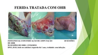 FERIDA TRATADA COM OHB
FOTO INICIAL COM INDICAÇÃO DE AMPUTAÇÃO 40 SESSÕES
DE OHB
50 SESSÕES DE OHB + ENXERTO
DM I, HAS, lesão no calcâneo esquerdo há 1 ano, evoluindo com infecção.
 