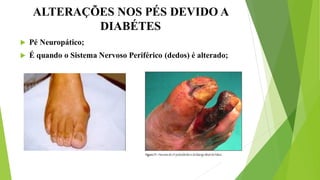 ALTERAÇÕES NOS PÉS DEVIDO A
DIABÉTES
 Pé Neuropático;
 É quando o Sistema Nervoso Periférico (dedos) é alterado;
 