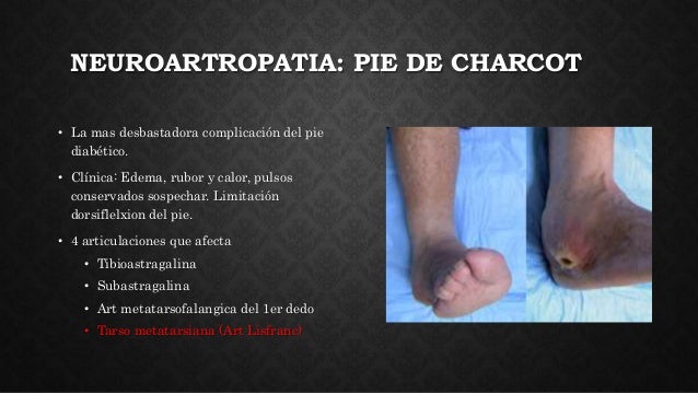 Diabetes mellitus tipo 1 y 2, criterios diagnosticos Diabetes mellitus tipo 1 y 2, criterios diagnosticos