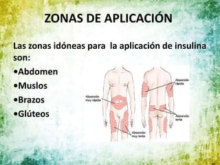 ZONAS DE APLICACIÓN
Las zonas idóneas para la aplicación de insulina
son:
•Abdomen
•Muslos
•Brazos
•Glúteos
 