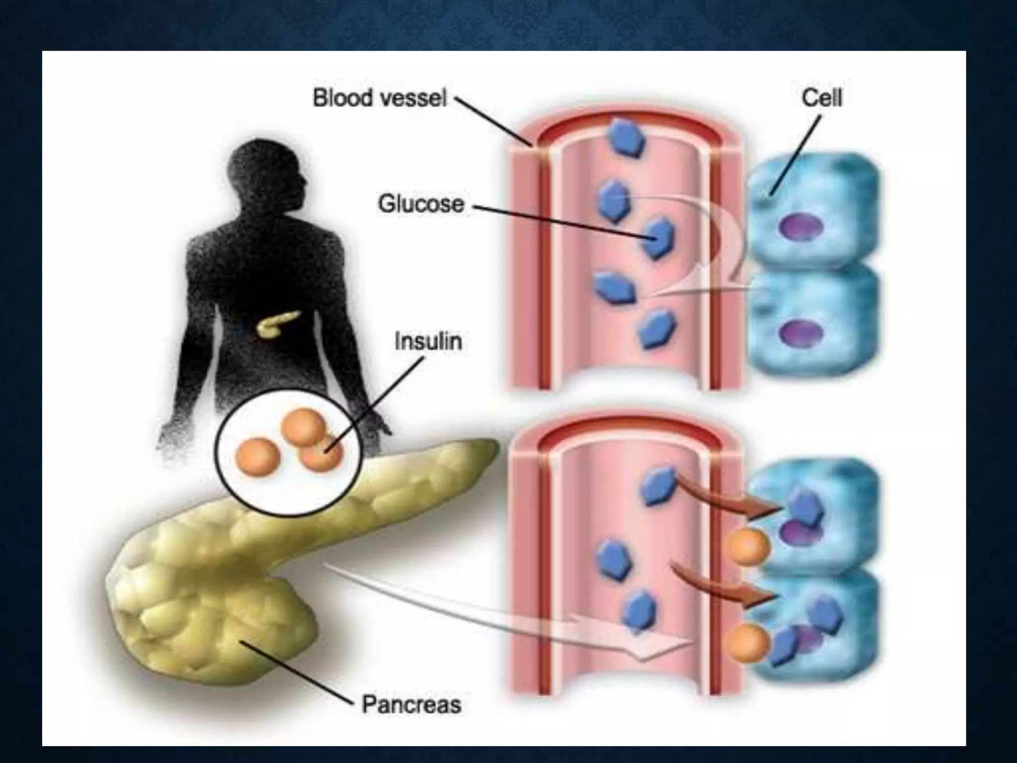 Diabetes Mellites type 1 and type 2 | PPTX