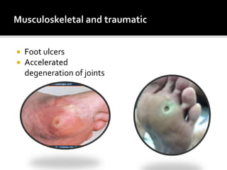  Foot ulcers
 Accelerated
degeneration of joints
 