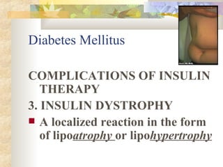 COMPLICATIONS OF INSULIN THERAPY 3. INSULIN DYSTROPHY A localized reaction in the form of lipo atrophy  or lipo hypertrophy  Diabetes Mellitus 