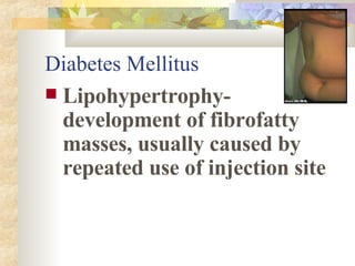 Lipohypertrophy- development of fibrofatty masses, usually caused by repeated use of injection site Diabetes Mellitus 