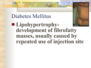 <ul><li>Lipohypertrophy- development of fibrofatty masses, usually caused by repeated use of injection site </li></ul>Diab...