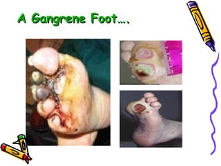 A Gangrene Foot…. 