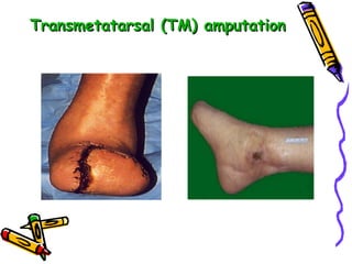 Transmetatarsal (TM) amputation 